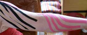 Kinesio taping of the arm