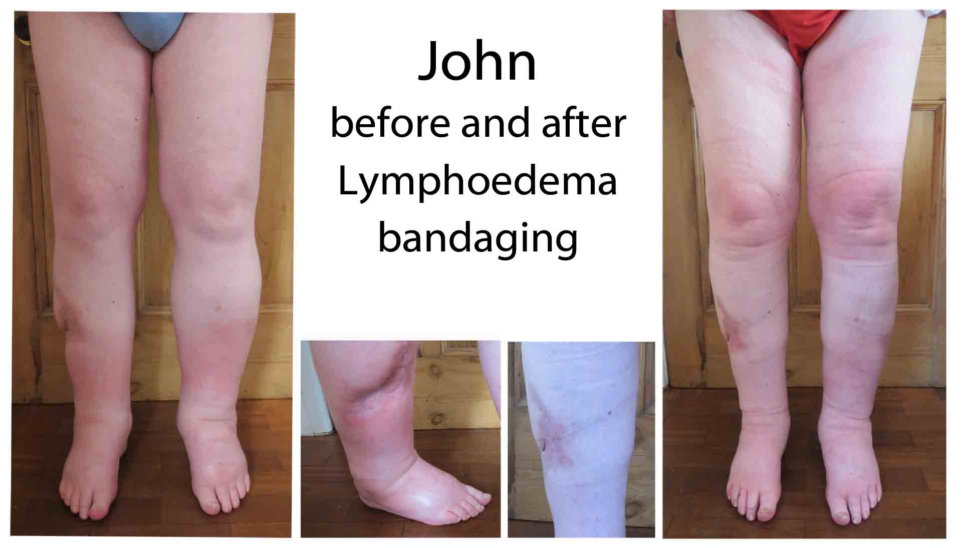 John before and after lymphoedema bandaging