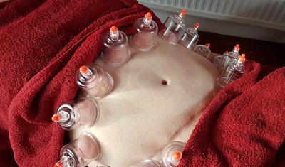 Myofascial dry cupping on abdomen