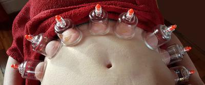 Myofascial dry cupping on abdomen