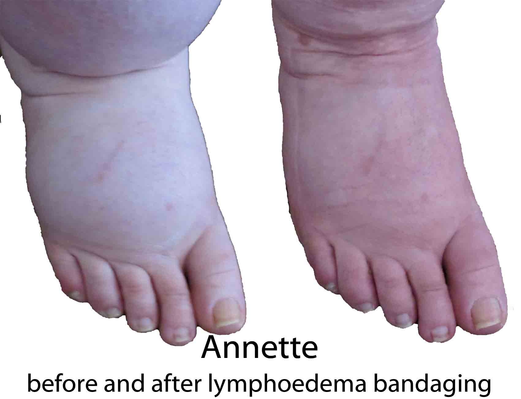 Annette before and after lymphoedema bandaging