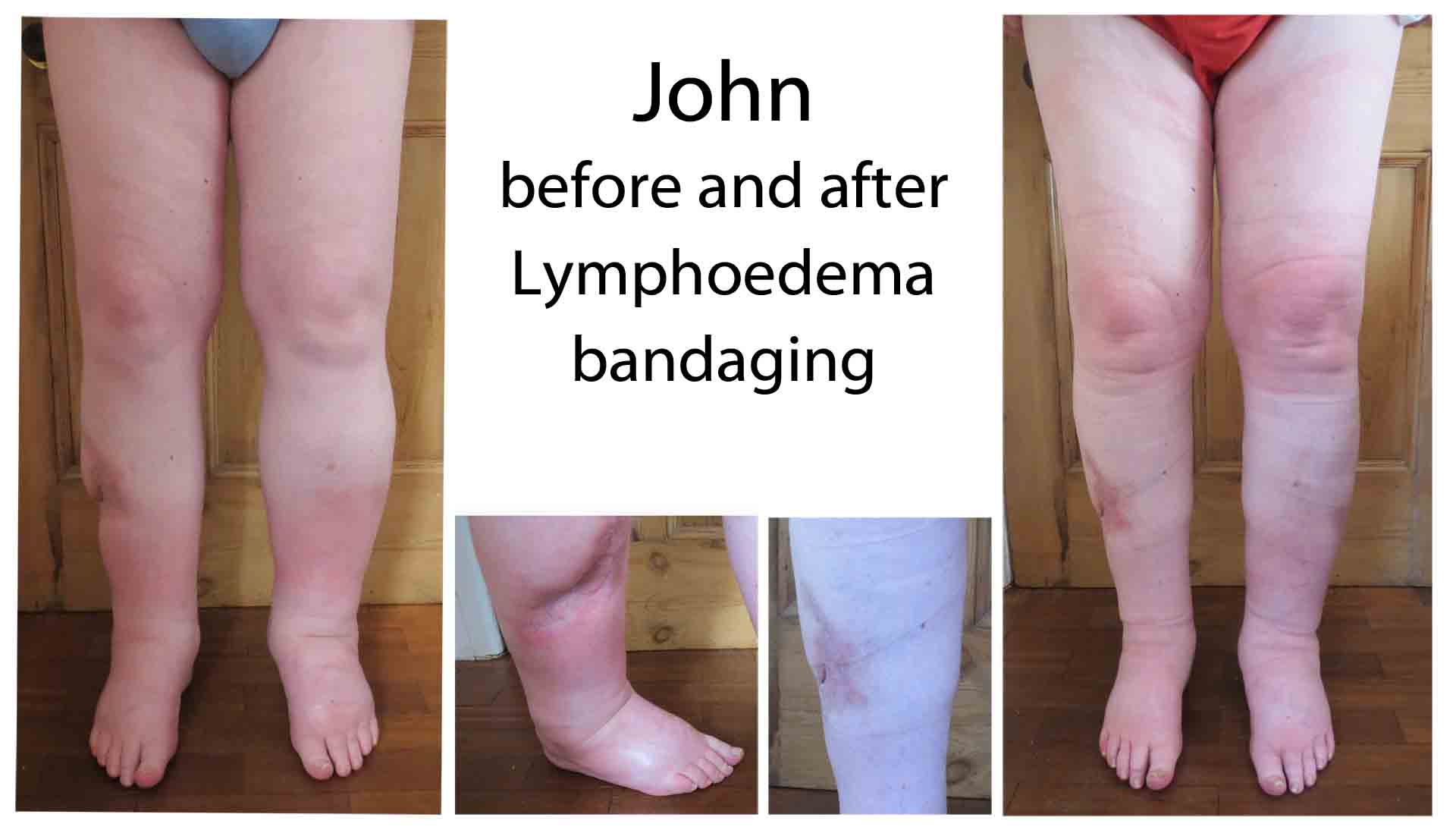 John before and after lymphoedema bandaging