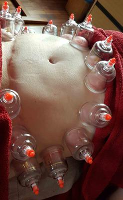 Myofascial dry cupping on abdomen (the scar is several months old)